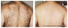 LASER HAIR REMOVAL - Man's Back